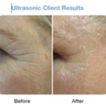 Ultrasonic facial