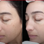 before and after chemical peel